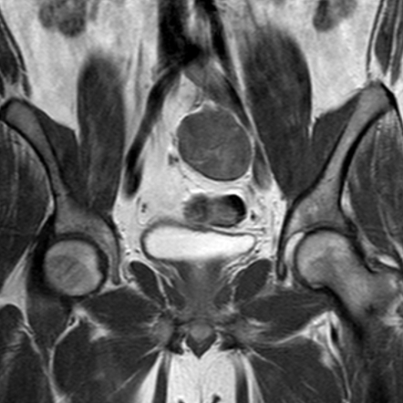 Pelvic schwannoma | Image | Radiopaedia.org