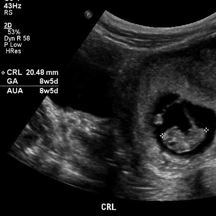 Fetal rhombencephalon | Image | Radiopaedia.org