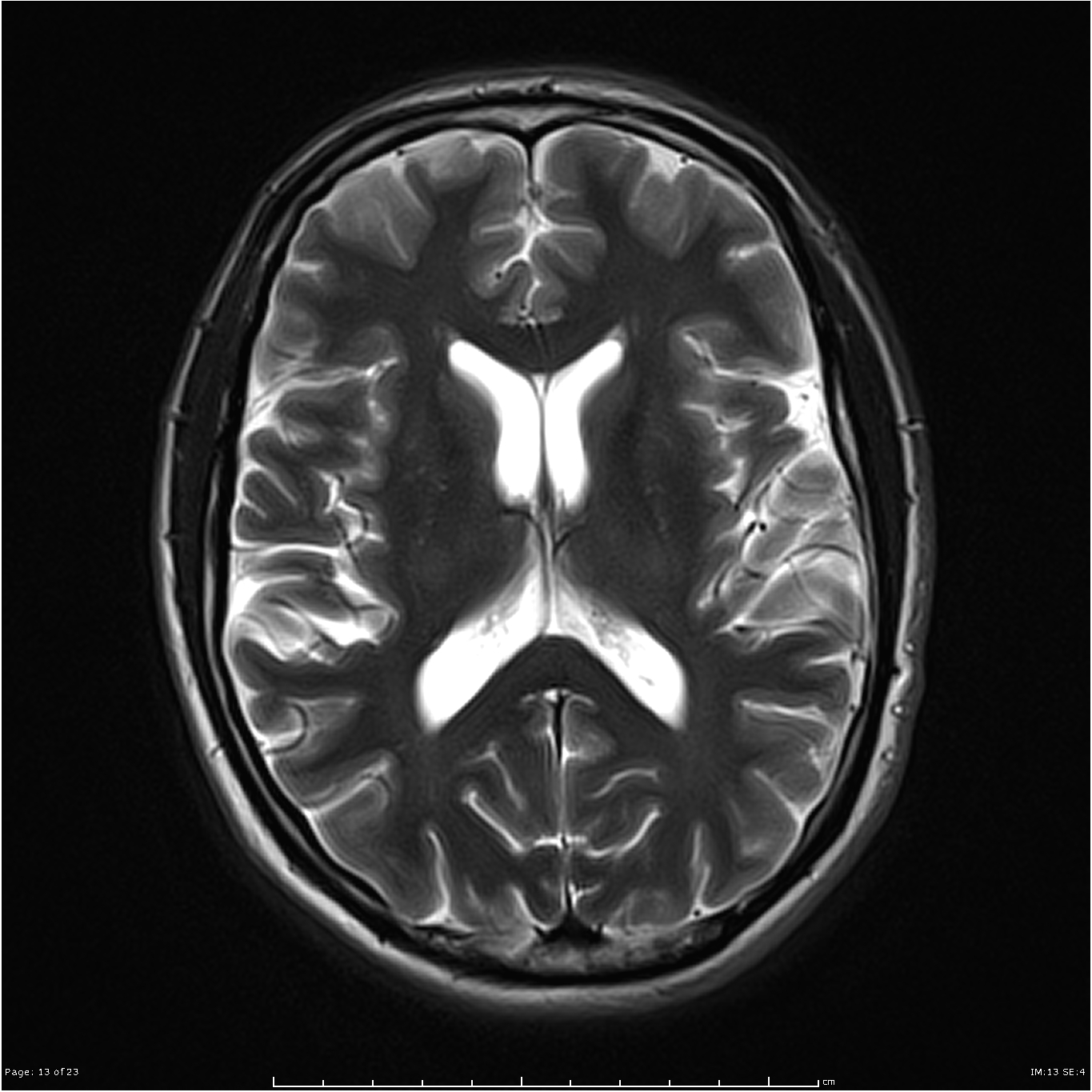 Cavum septum pellucidum | Image | Radiopaedia.org