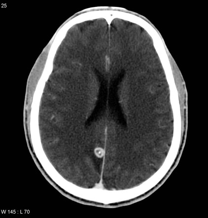 neurocysticercosis