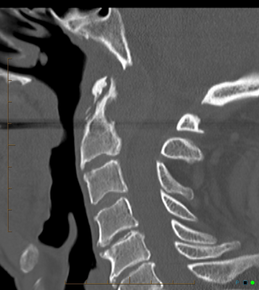 Pannus at the cranio-cervical junction: CT and MRI findings | Image ...