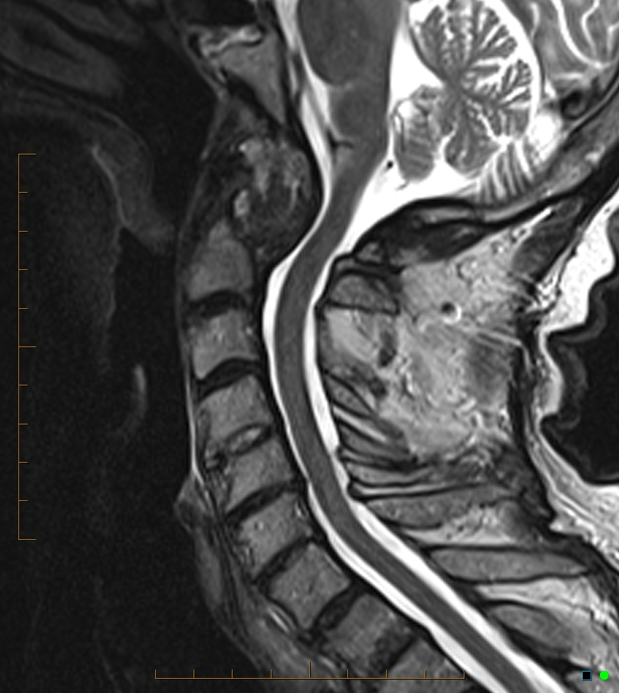 Pannus At The Cranio Cervical Junction Ct And Mri Findings Image