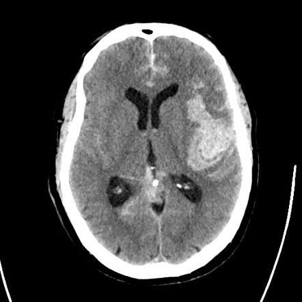 Subarachnoid haemorrhage due to aneurysm rupture | Radiology Case ...