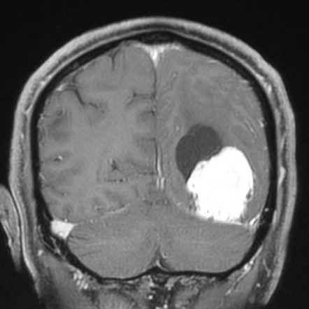 Solitary fibrous tumor (hemangiopericytoma) | Image | Radiopaedia.org