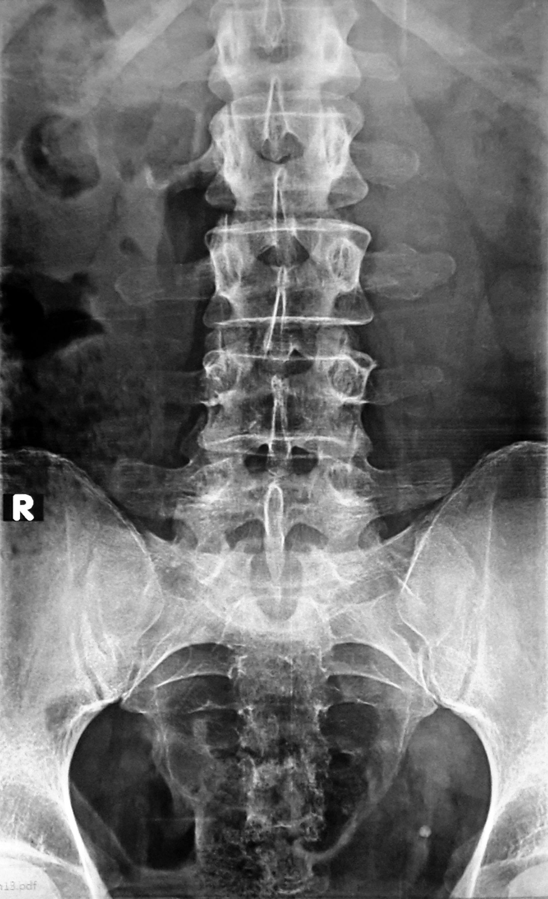 Spina. Spina Bifida l5 позвонка рентген.