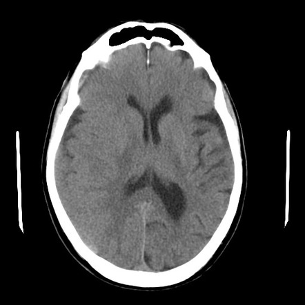 Subdural Hematoma And Colloid Cyst Radiology Case Radiopaedia Org