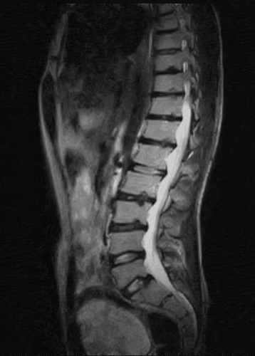 Schmorl nodes | Image | Radiopaedia.org