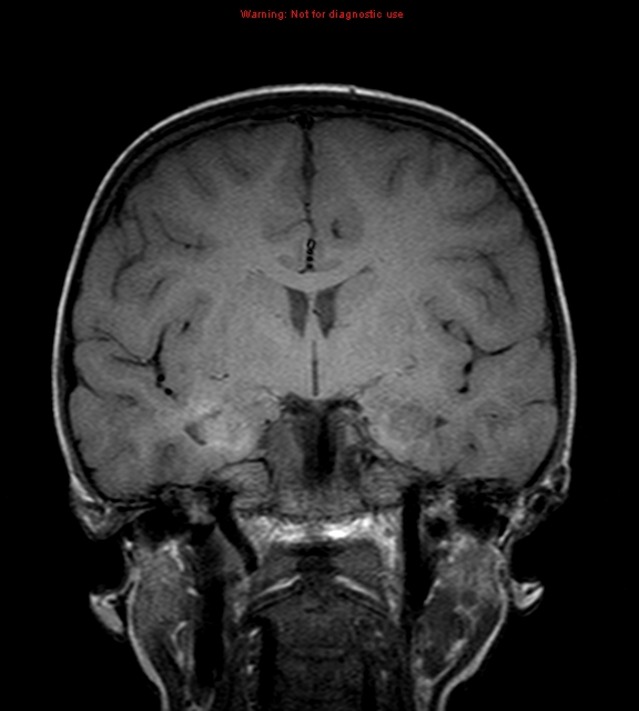 Rosai–Dorfman Disease | Image | Radiopaedia.org