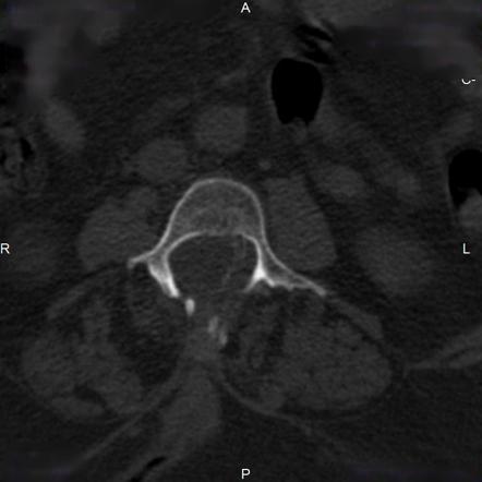 Spinal dysraphism Radiology Reference Article Radiopaedia