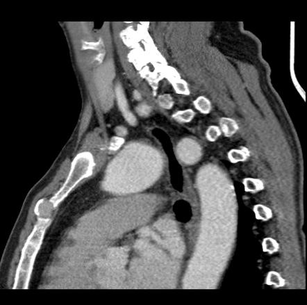 Arteria lusoria | Image | Radiopaedia.org