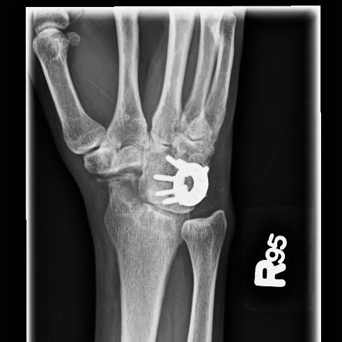 File:Four-corner fusion (intercarpal arthrodesis of the capitate ...