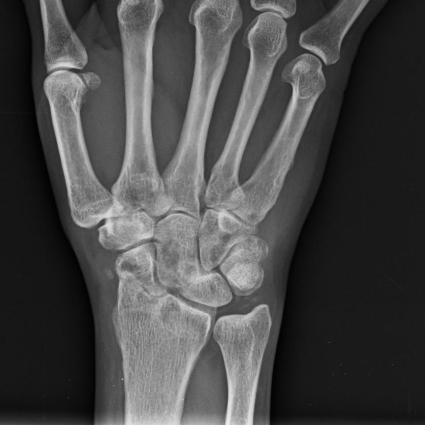 File:Four-corner fusion (intercarpal arthrodesis of the capitate ...