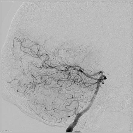 Mother in law sign | Radiology Reference Article | Radiopaedia.org