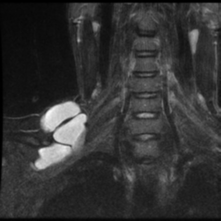 Lymphangioma | Radiology Reference Article | Radiopaedia.org