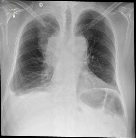 Bronchogenic carcinoma with metastatic lymphadenopathy | Radiology Case ...