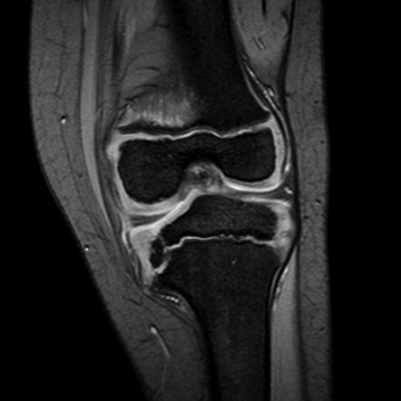 Blount disease | Radiology Reference Article | Radiopaedia.org