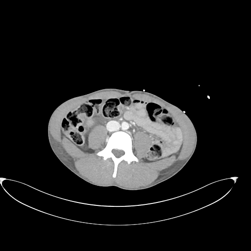 Rhabdomyolysis | Image | Radiopaedia.org