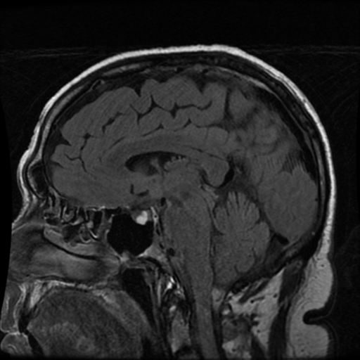 Acute Disseminated Encephalomyelitis | Image | Radiopaedia.org