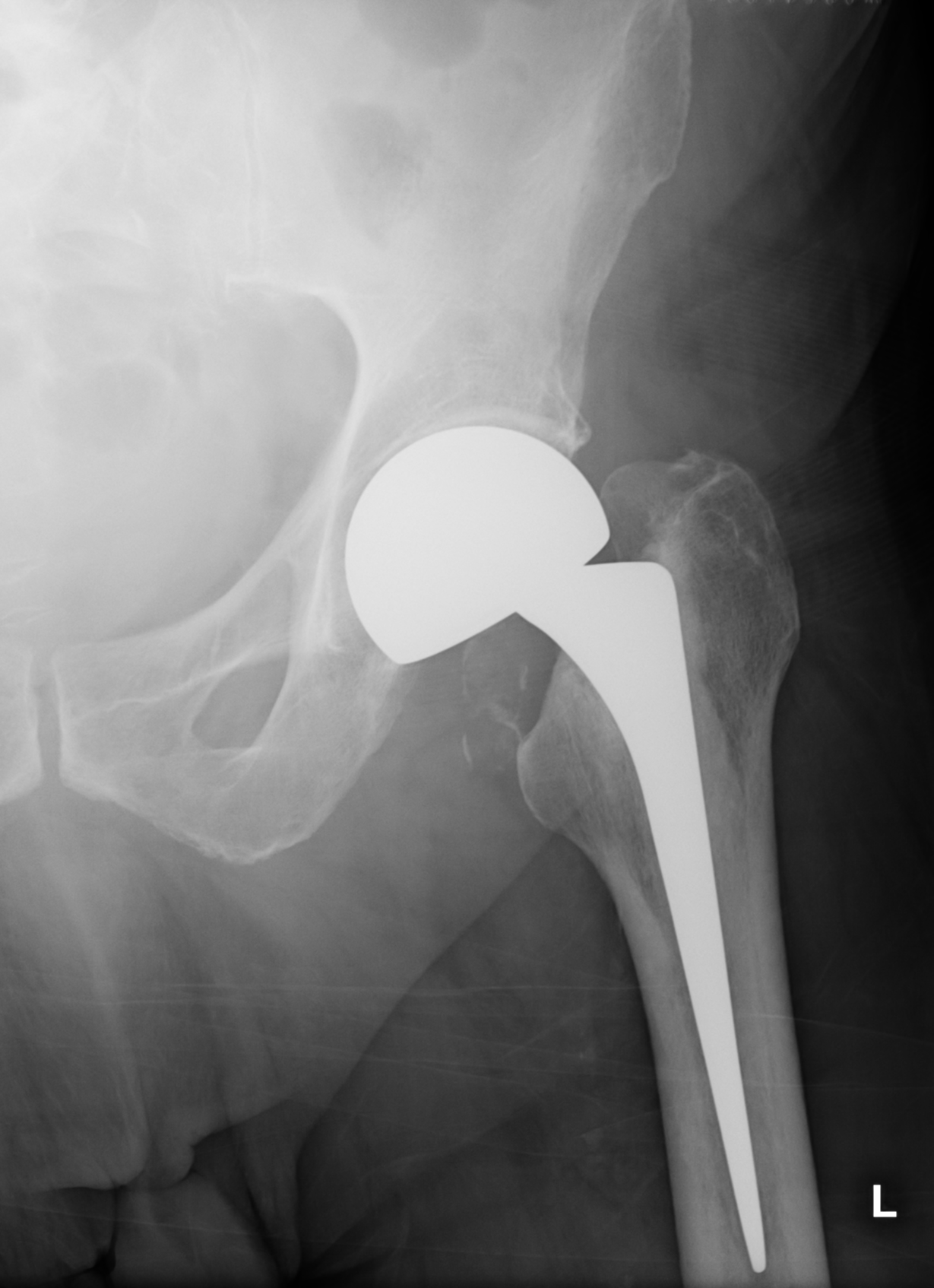 Hip hemiarthroplasty | Image | Radiopaedia.org