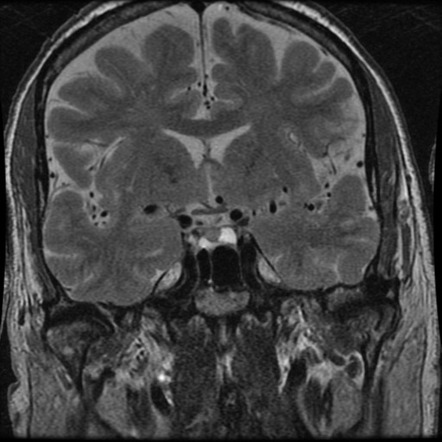 Acute disseminated encephalomyelitis | Image | Radiopaedia.org