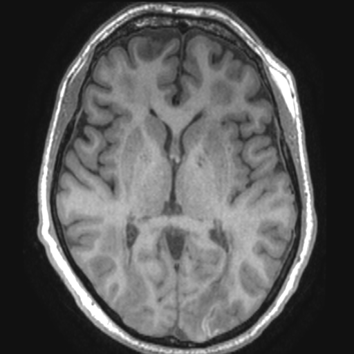 Acute disseminated encephalomyelitis | Image | Radiopaedia.org