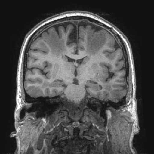 Acute disseminated encephalomyelitis | Image | Radiopaedia.org