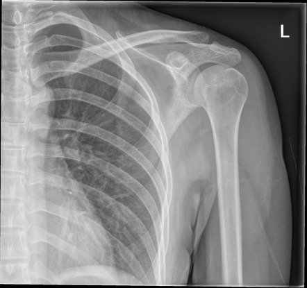 Normal shoulder with internal and external rotation | Radiology Case ...