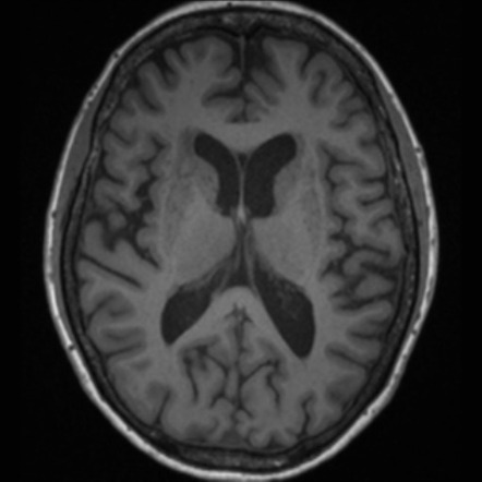 Medial temporal lobe atrophy | Image | Radiopaedia.org