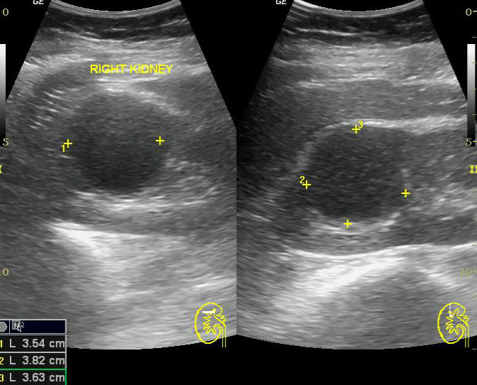 Рак почки узи картина