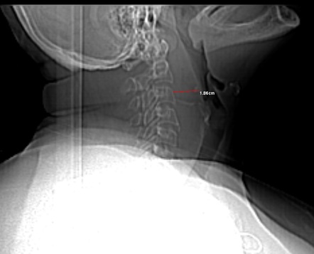 Retropharyngeal abscess | Radiology Reference Article | Radiopaedia.org