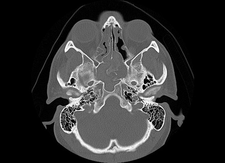 Allergic fungal sinusitis | Image | Radiopaedia.org