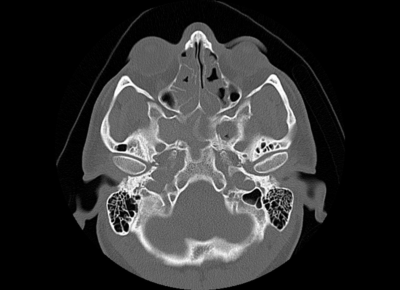 Allergic fungal sinusitis | Image | Radiopaedia.org