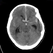 Subarachnoid hemorrhage  Radiology Reference Article