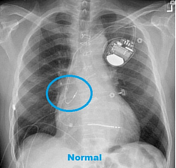 Dual Chamber Pacemaker Xray