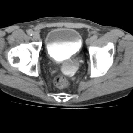 Urinary bladder hernia | Radiology Reference Article | Radiopaedia.org