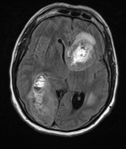 Melanoma cerebral metastasis | Image | Radiopaedia.org