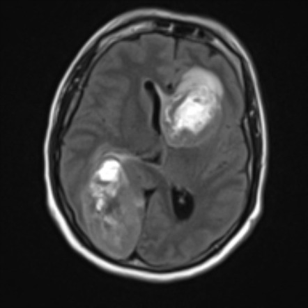 Melanoma cerebral metastasis | Image | Radiopaedia.org