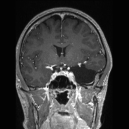 Middle cranial fossa arachnoid cyst | Image | Radiopaedia.org