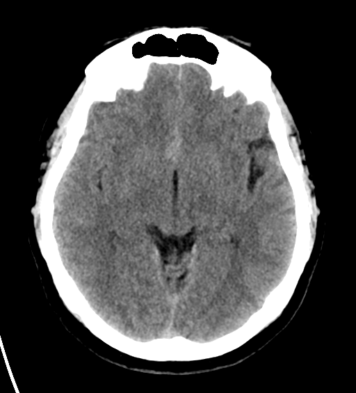 Ruptured Anterior Communicating Artery Aneurysm Image