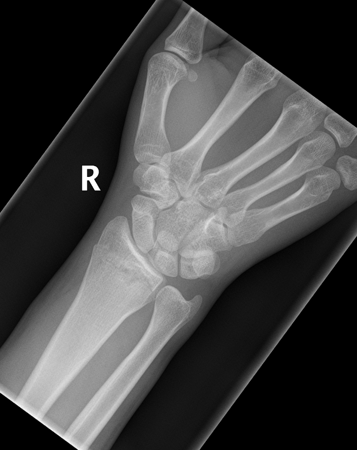 Distal radius and scaphoid fractures | Image | Radiopaedia.org