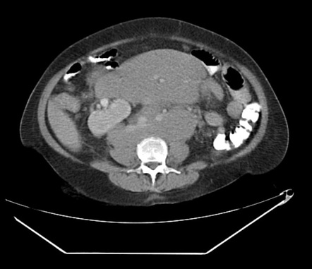 Binet staging system for chronic lymphocytic leukemia | Radiology ...