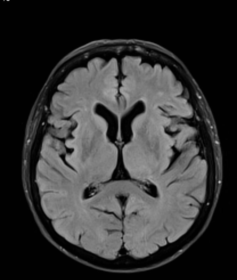 Transient global amnesia | Image | Radiopaedia.org