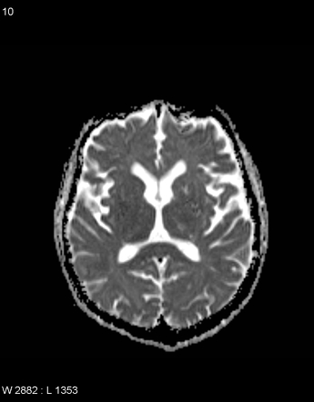 Transient global amnesia | Image | Radiopaedia.org