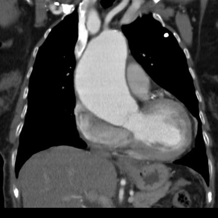 Thoracic Aortic Aneurysm Radiology Reference Article Radiopaedia Org