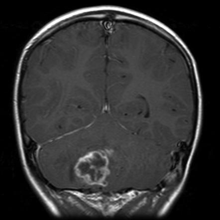 Pilocytic astrocytoma | Image | Radiopaedia.org