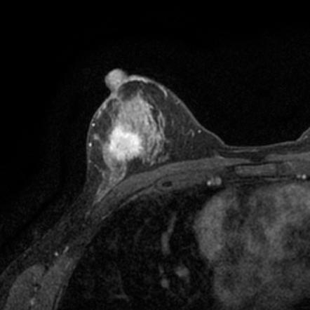 Breast Magnetic Resonance Imaging (MRI)