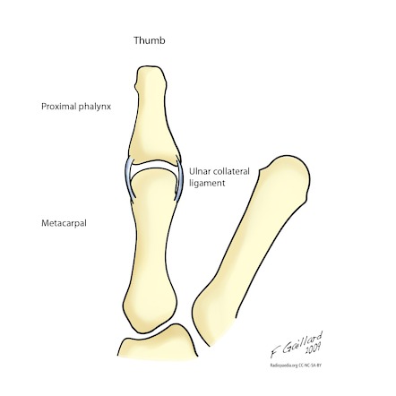 Gamekeeper's thumb | Radiology Reference Article | Radiopaedia.org