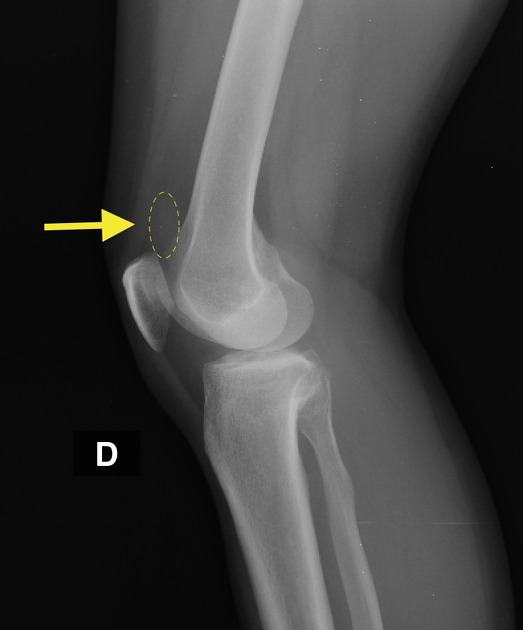 Joint Effusion (Swollen Joint): Symptoms, Causes, And, 46% OFF