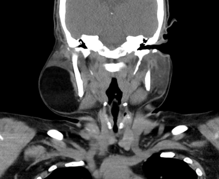 Parotid lipoma | Radiology Reference Article | Radiopaedia.org