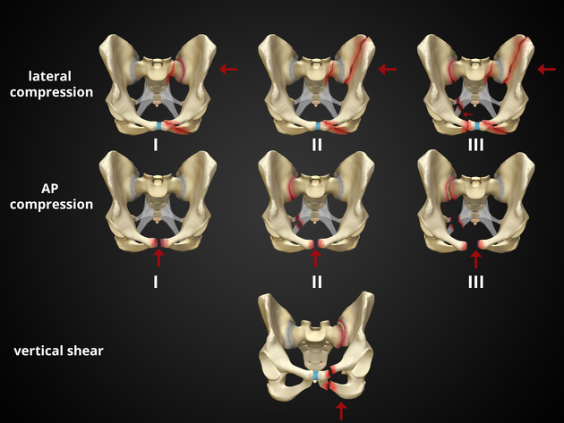 Types of Pelvis Fractures